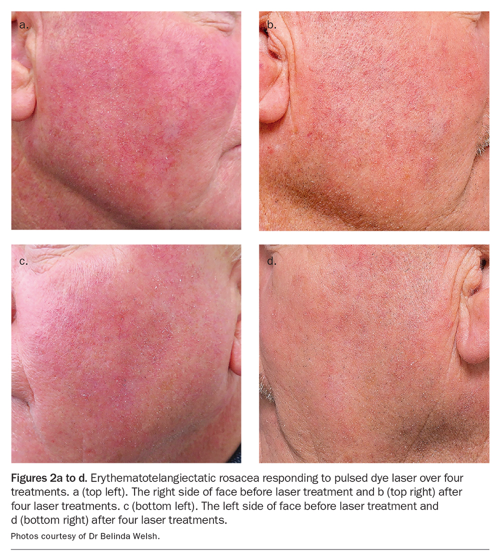 Rosacea a thorny problem with a rosy outlook Medicine Today